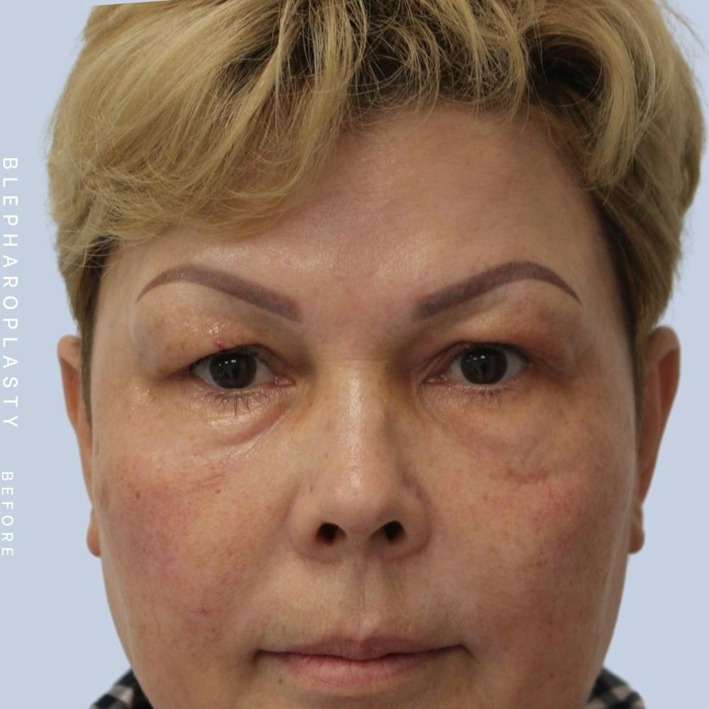 Eyes Before & After Gallery - Patient 108744044 - Image 3