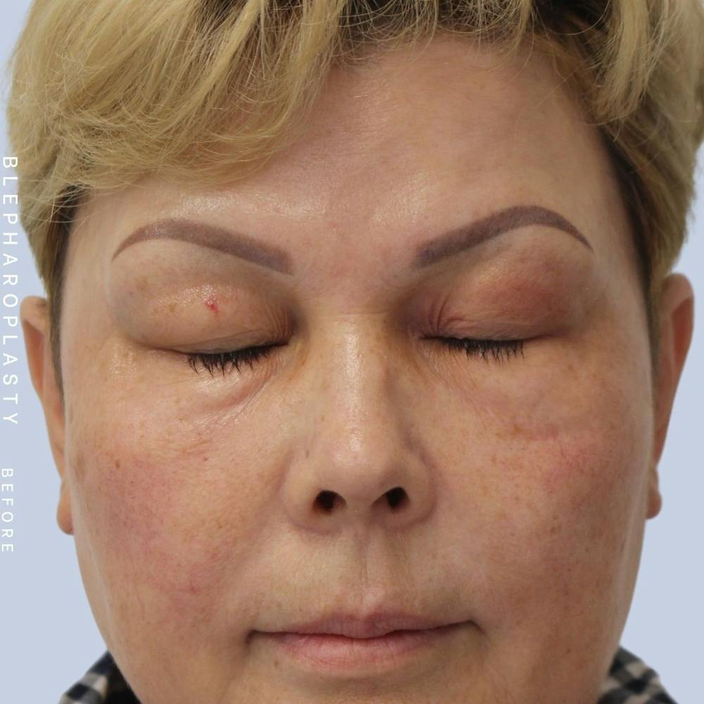 Eyes Before & After Gallery - Patient 108744044 - Image 5