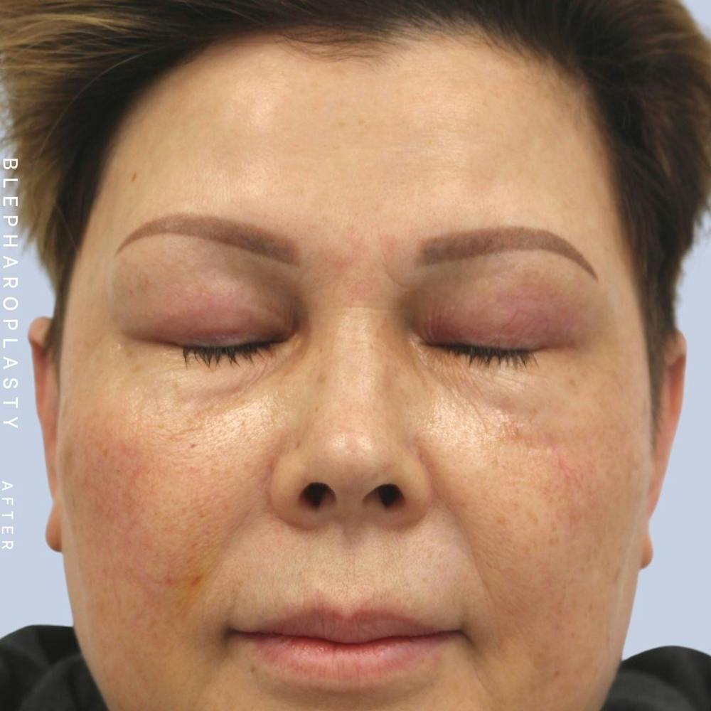 Eyes Before & After Gallery - Patient 108744044 - Image 6