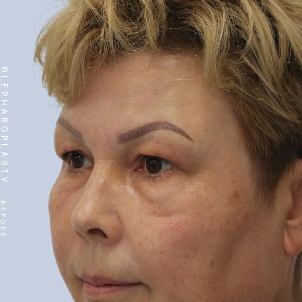 Eyes Before & After Gallery - Patient 108744044 - Image 7