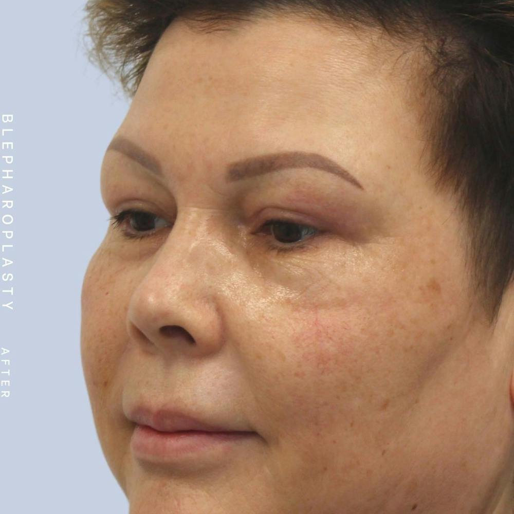 Eyes Before & After Gallery - Patient 108744044 - Image 8