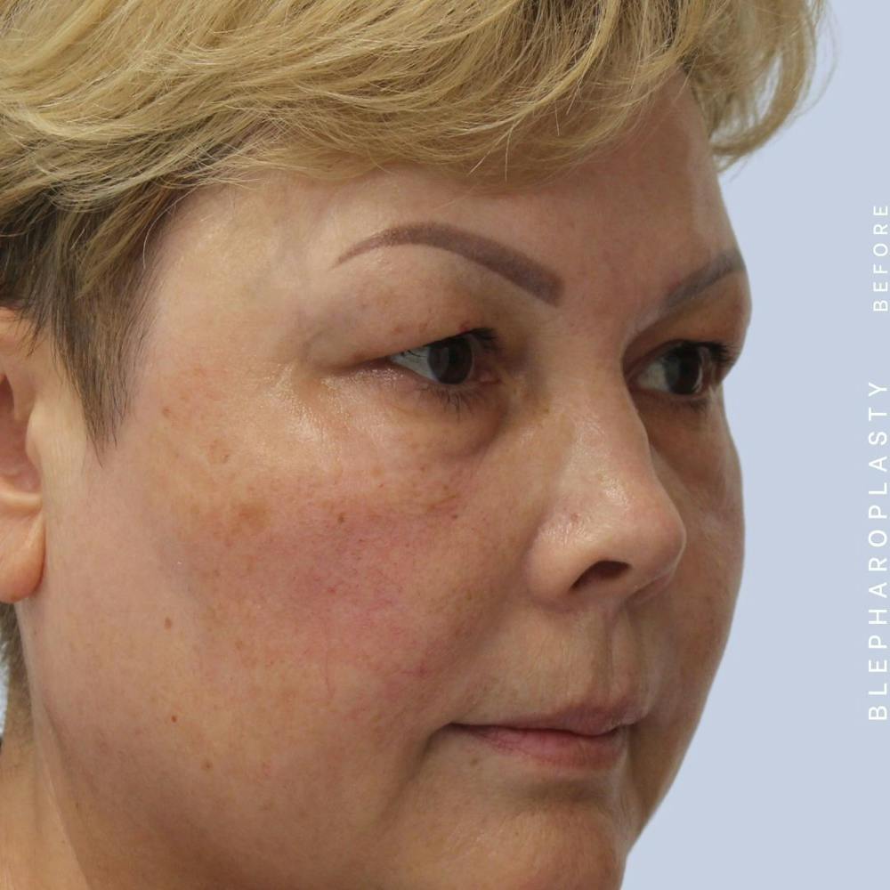 Eyes Before & After Gallery - Patient 108744044 - Image 9