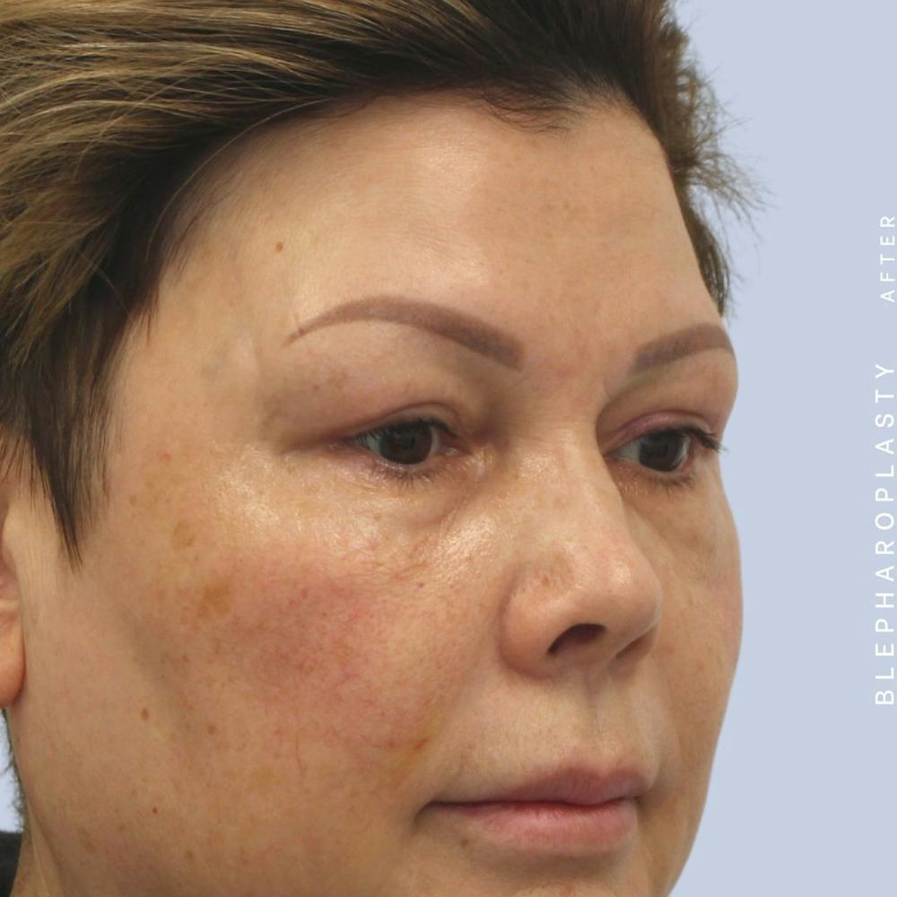 Eyes Before & After Gallery - Patient 108744044 - Image 10