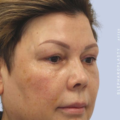 Eyes Before & After Gallery - Patient 108744044 - Image 10