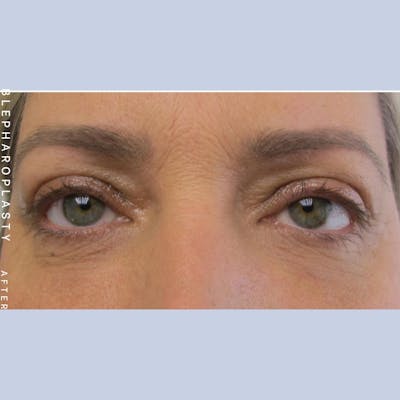 Eyes Before & After Gallery - Patient 108744045 - Image 1
