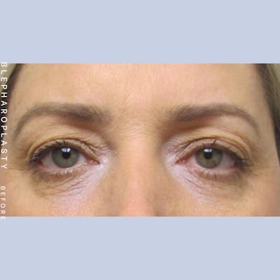 Eyes Before & After Gallery - Patient 108744045 - Image 2