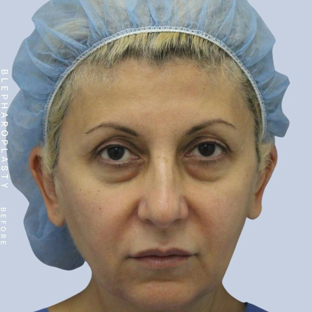 Eyes Before & After Gallery - Patient 120868157 - Image 1