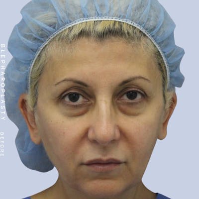 Eyes Before & After Gallery - Patient 120868157 - Image 1
