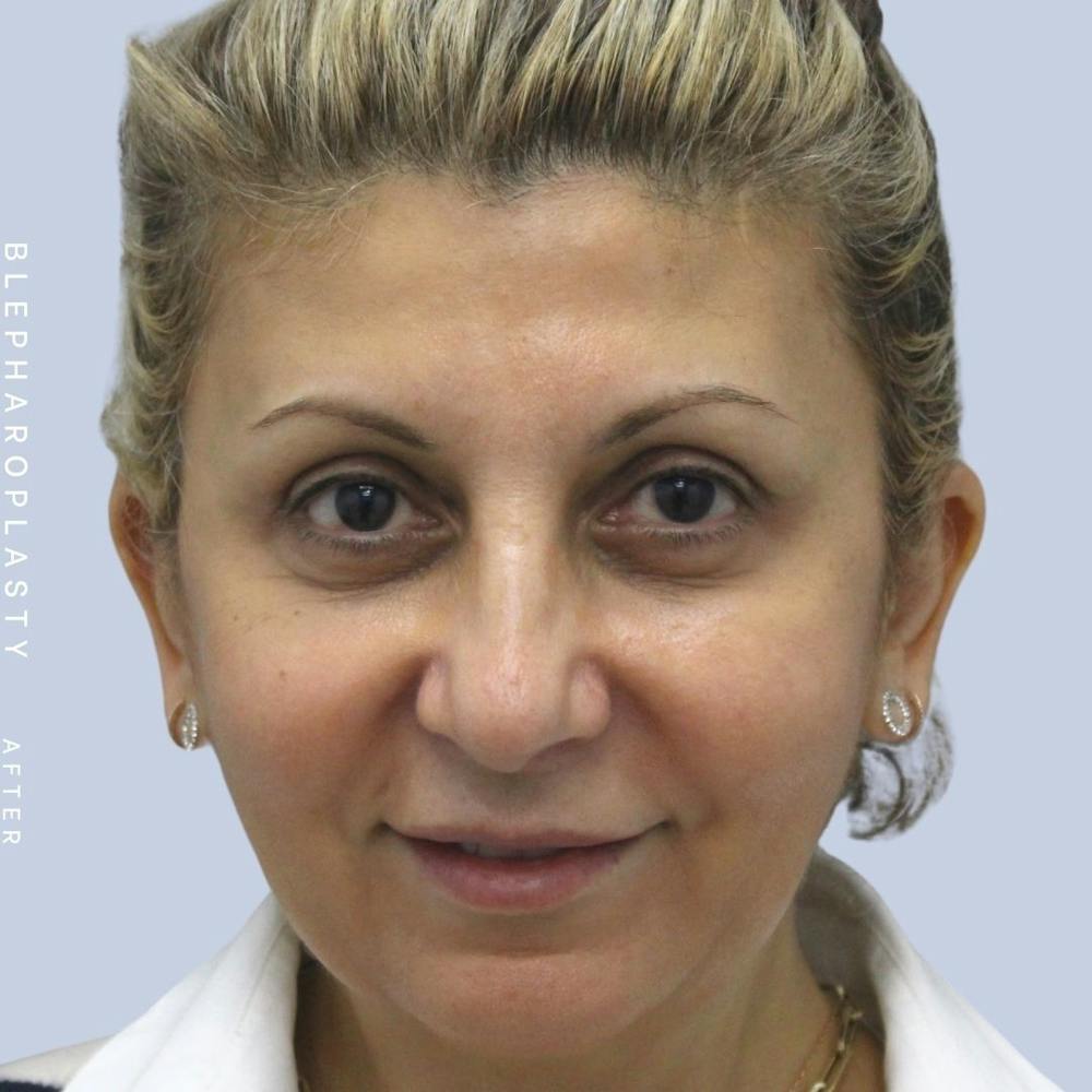 Eyes Before & After Gallery - Patient 120868157 - Image 2