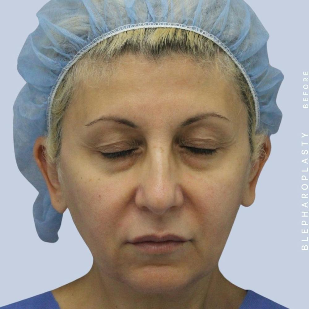 Eyes Before & After Gallery - Patient 120868157 - Image 3