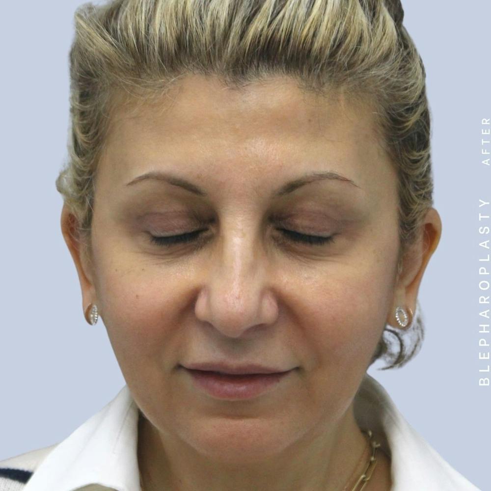 Eyes Before & After Gallery - Patient 120868157 - Image 4