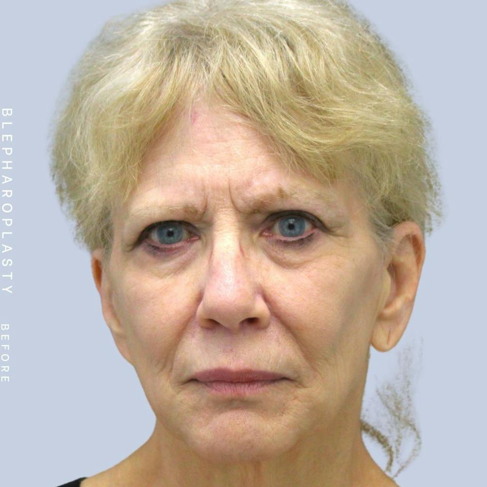 Eyes Before & After Gallery - Patient 120868689 - Image 1