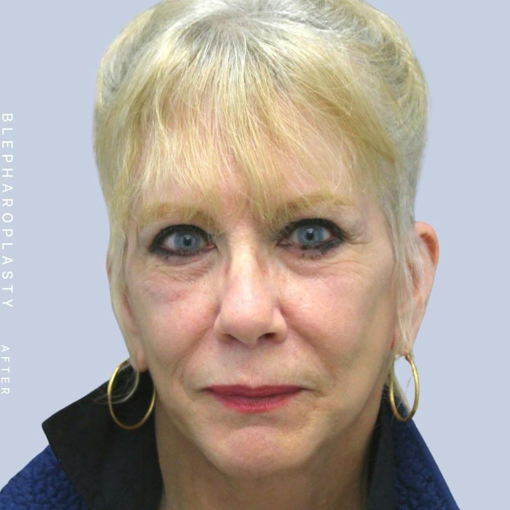 Face & Neck Before & After Gallery - Patient 120868687 - Image 2