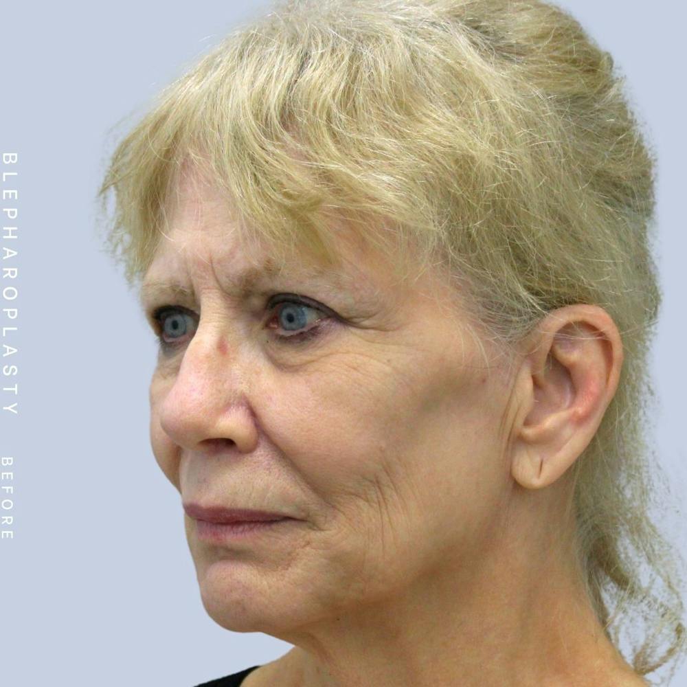Eyes Before & After Gallery - Patient 120868689 - Image 3