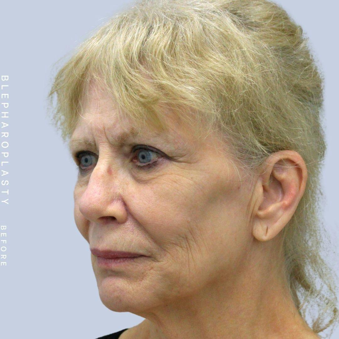 Face & Neck Before & After Gallery - Patient 120868687 - Image 3