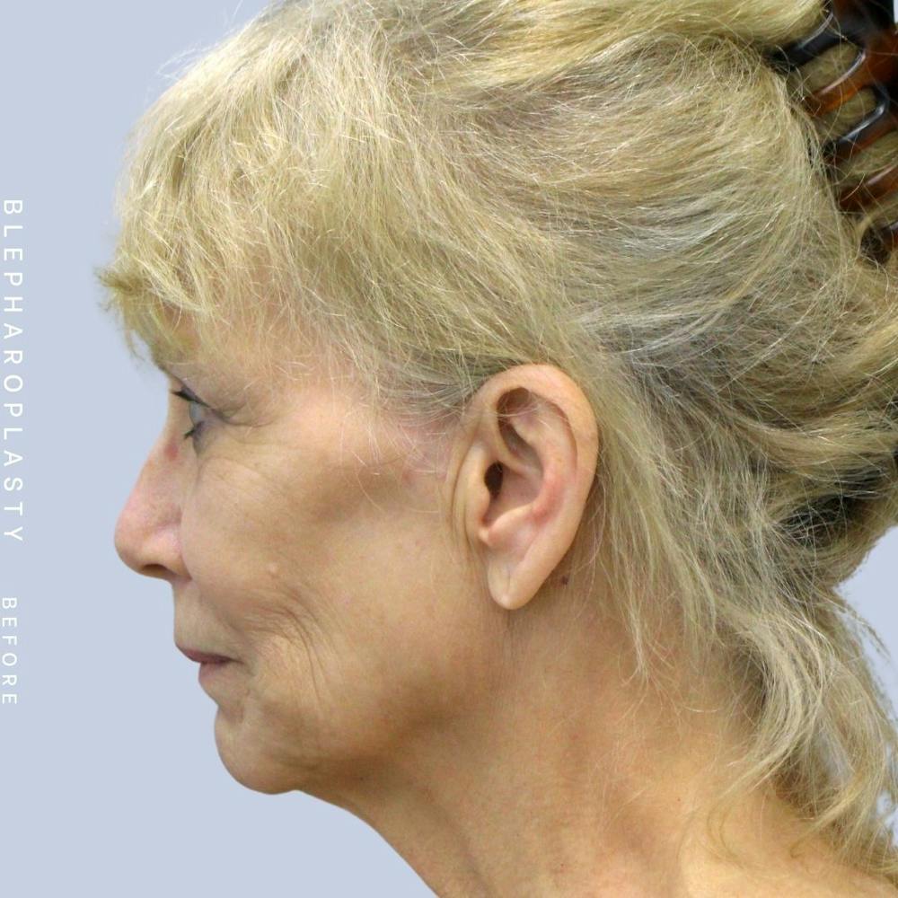 Face & Neck Before & After Gallery - Patient 120868687 - Image 5