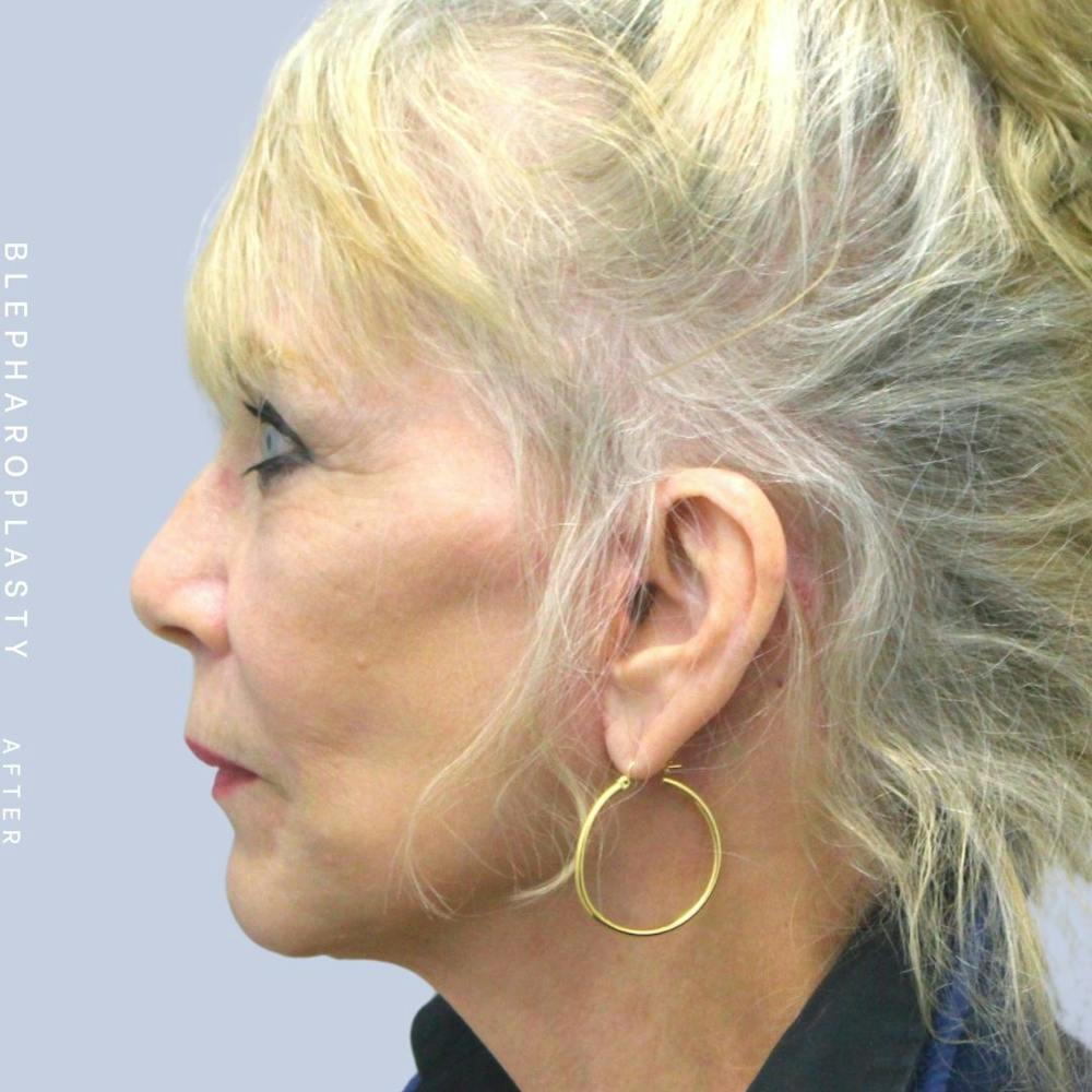 Eyes Before & After Gallery - Patient 120868689 - Image 6