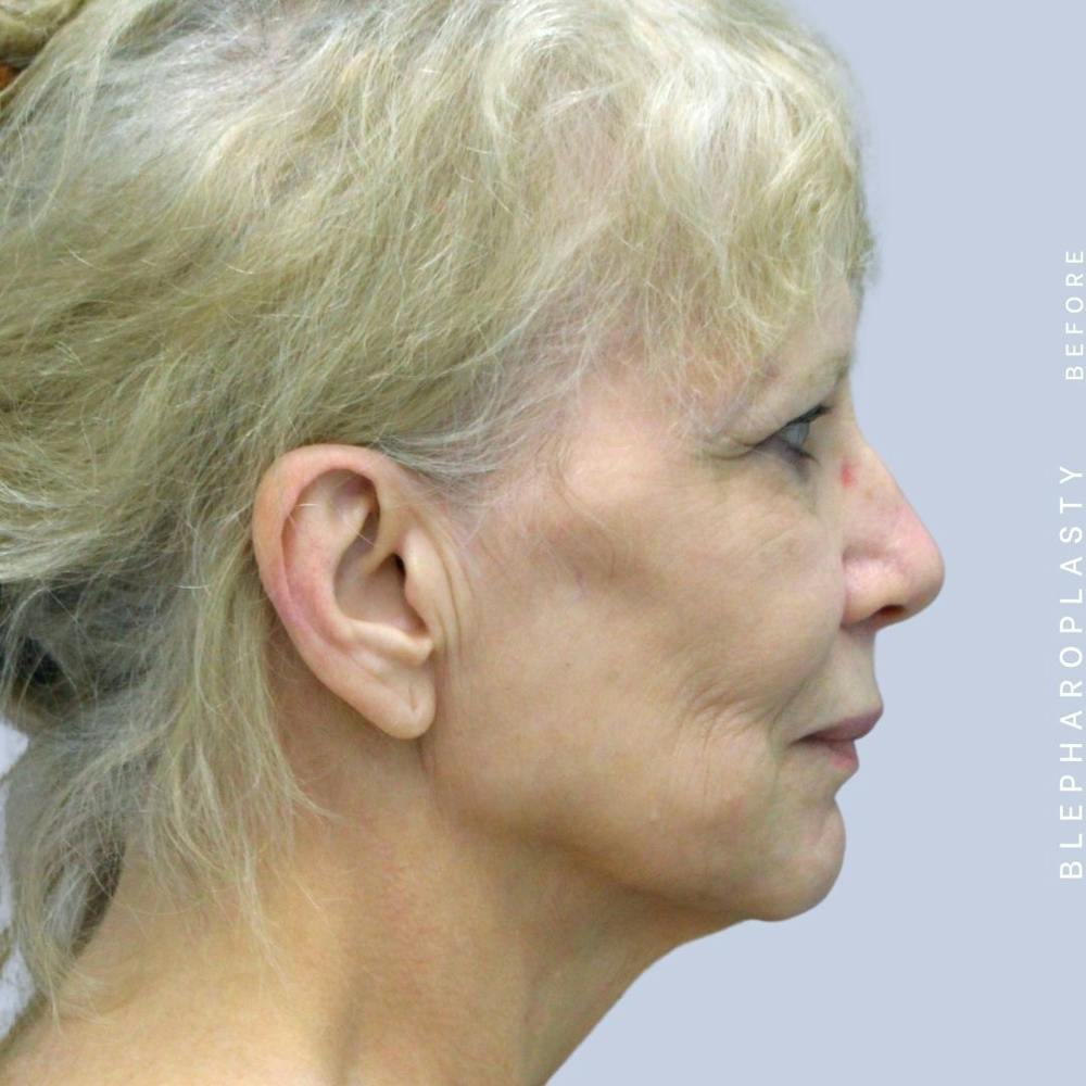Eyes Before & After Gallery - Patient 120868689 - Image 7