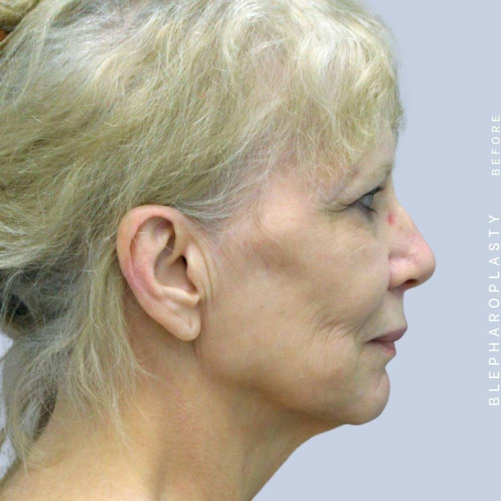 Face & Neck Gallery - Patient 120868687 - Image 7