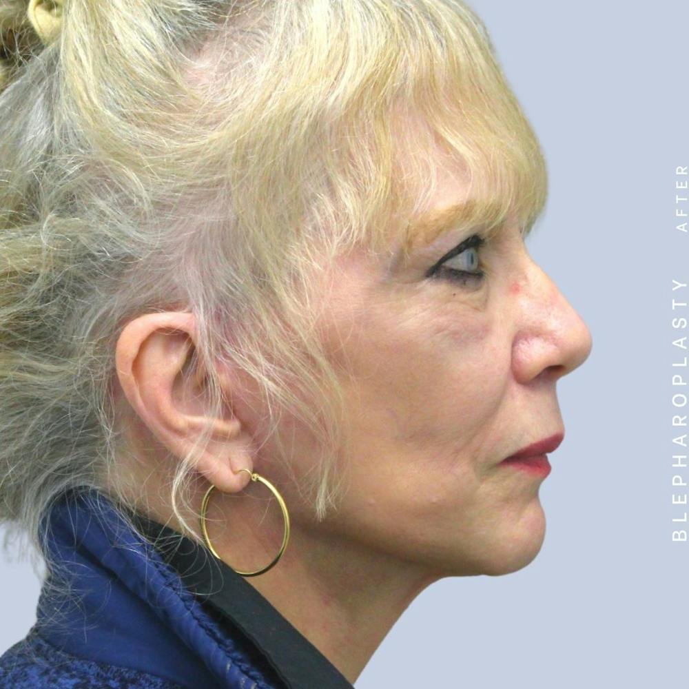 Eyes Before & After Gallery - Patient 120868689 - Image 8