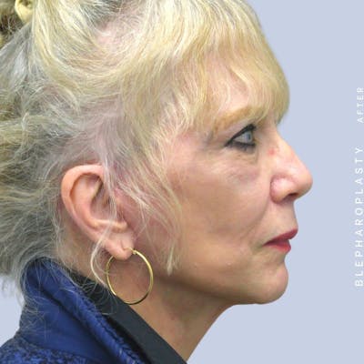 Face & Neck Before & After Gallery - Patient 120868687 - Image 8