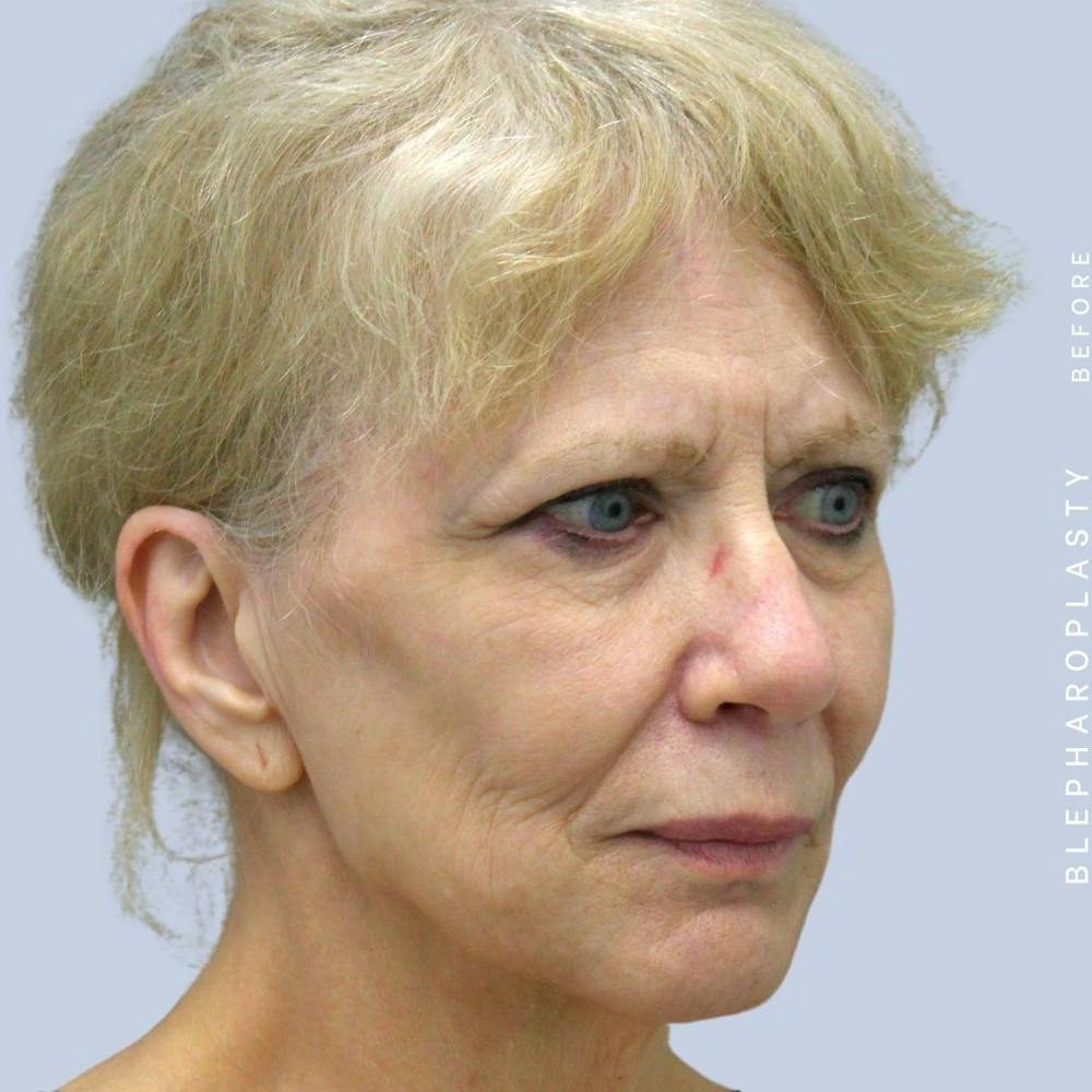 Eyes Before & After Gallery - Patient 120868689 - Image 9