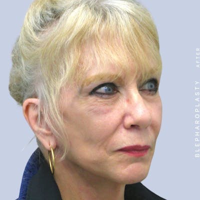 Eyes Before & After Gallery - Patient 120868689 - Image 10