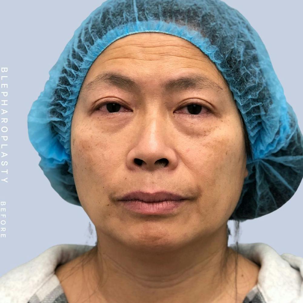 Eyes Before & After Gallery - Patient 120868714 - Image 1