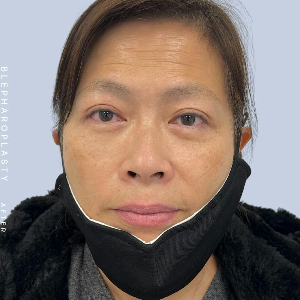 Eyes Before & After Gallery - Patient 120868714 - Image 2