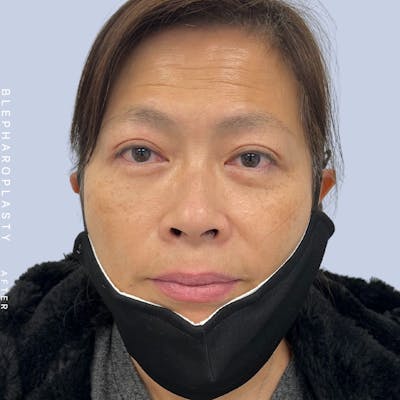 Eyes Before & After Gallery - Patient 120868714 - Image 2
