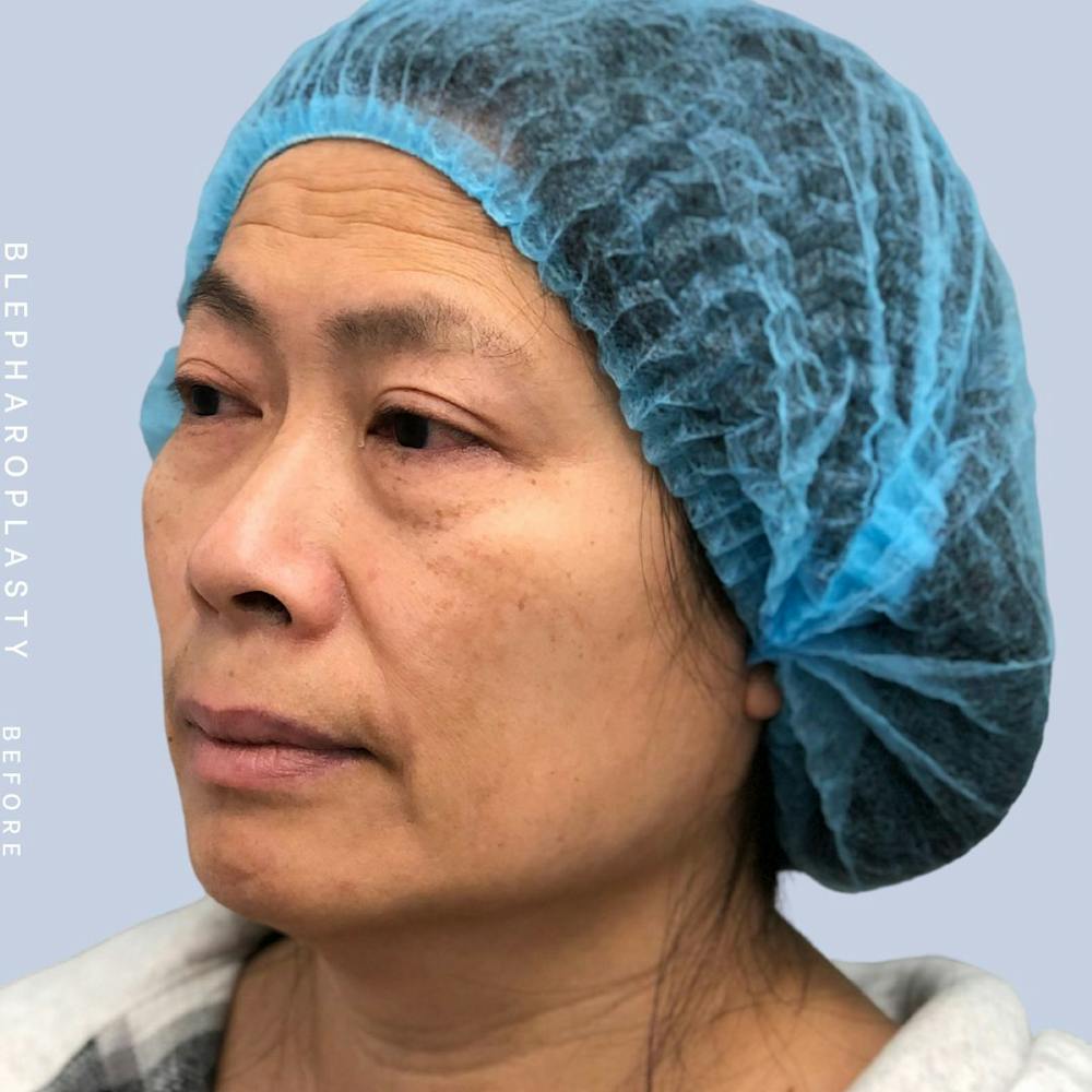 Eyes Before & After Gallery - Patient 120868714 - Image 3
