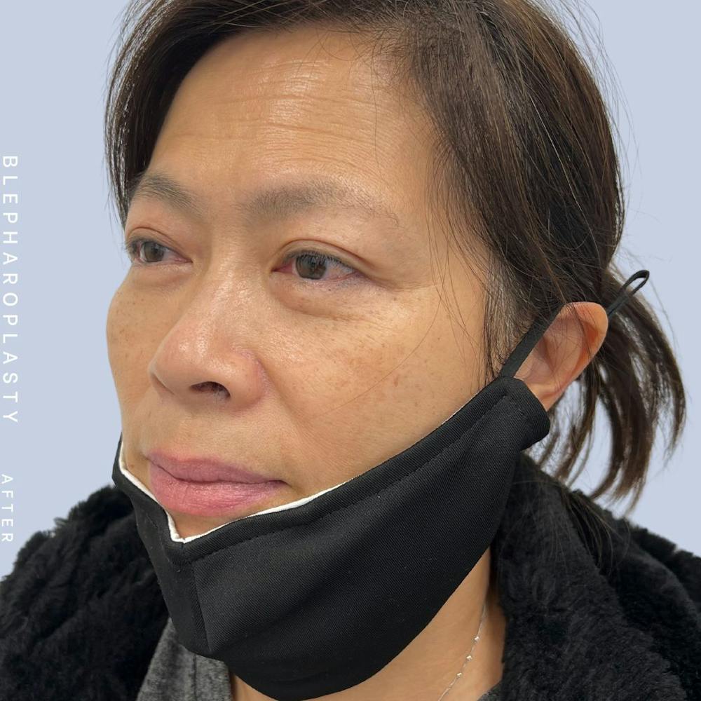 Eyes Before & After Gallery - Patient 120868714 - Image 4