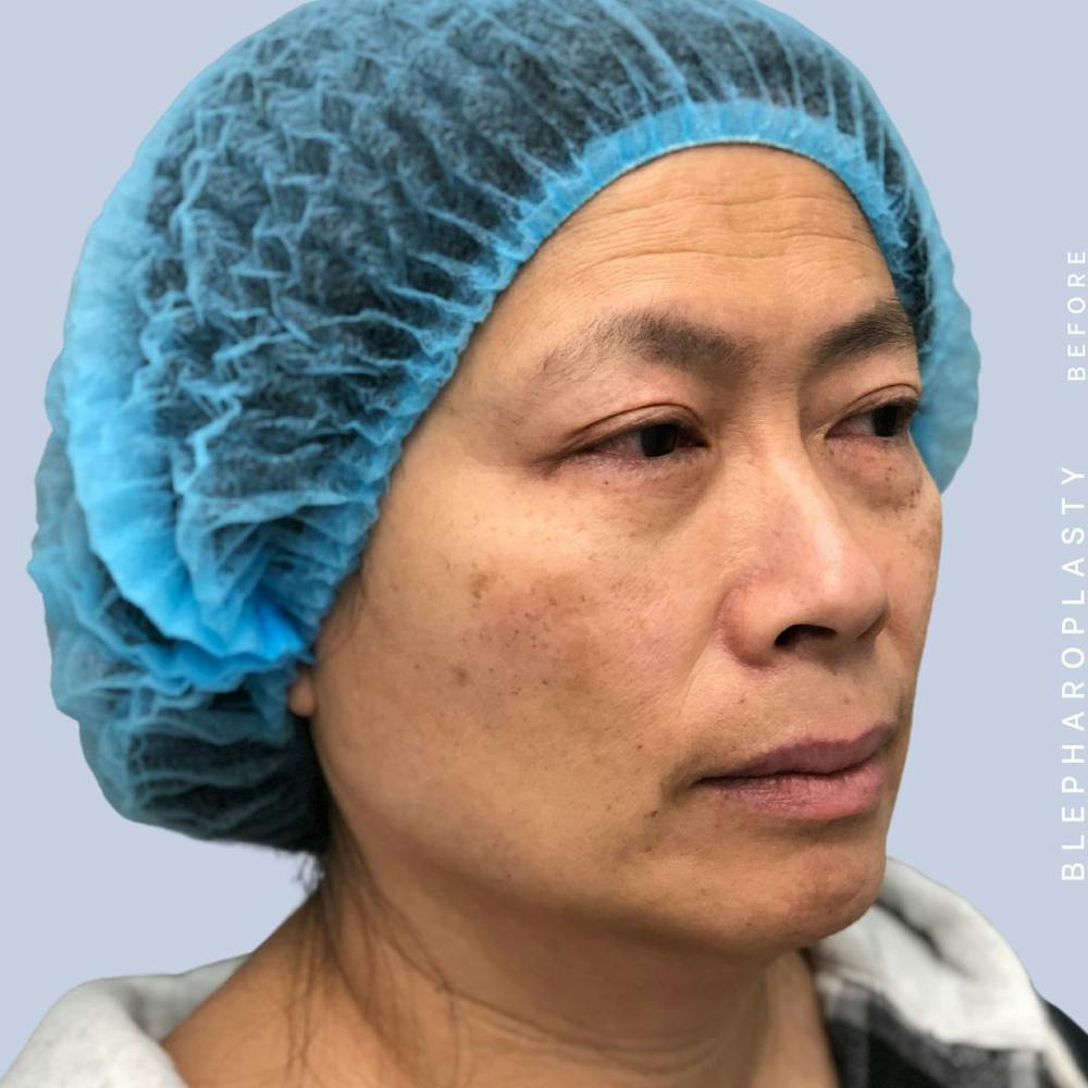 Eyes Before & After Gallery - Patient 120868714 - Image 5