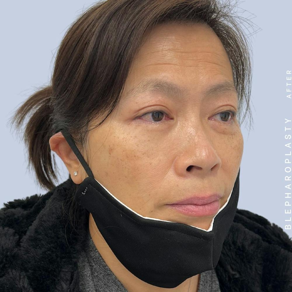 Eyes Before & After Gallery - Patient 120868714 - Image 6