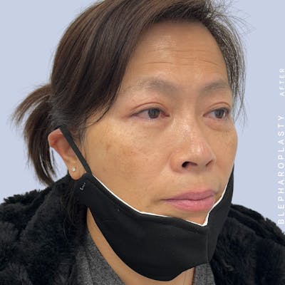 Eyes Before & After Gallery - Patient 120868714 - Image 6