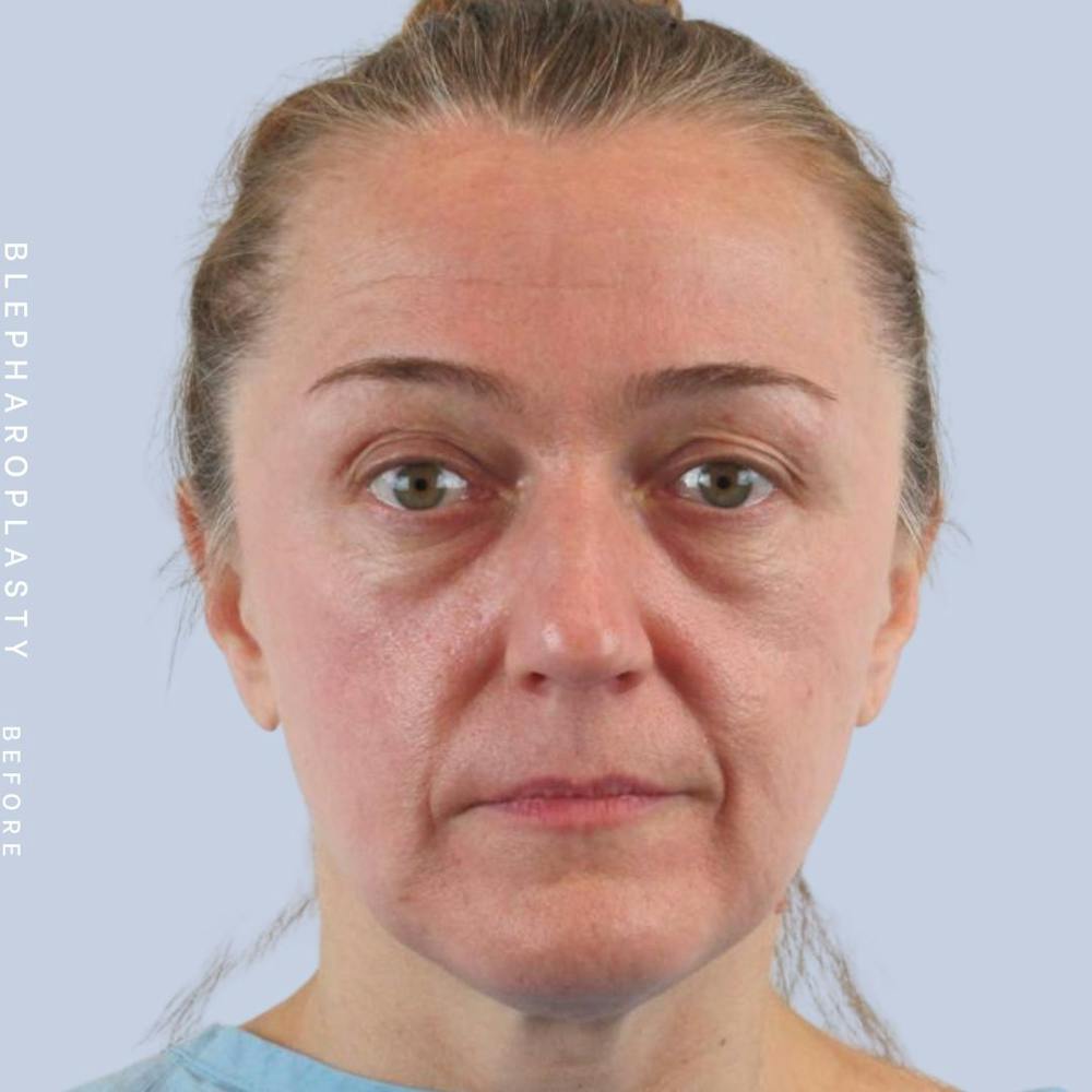 Eyes Before & After Gallery - Patient 121500210 - Image 1