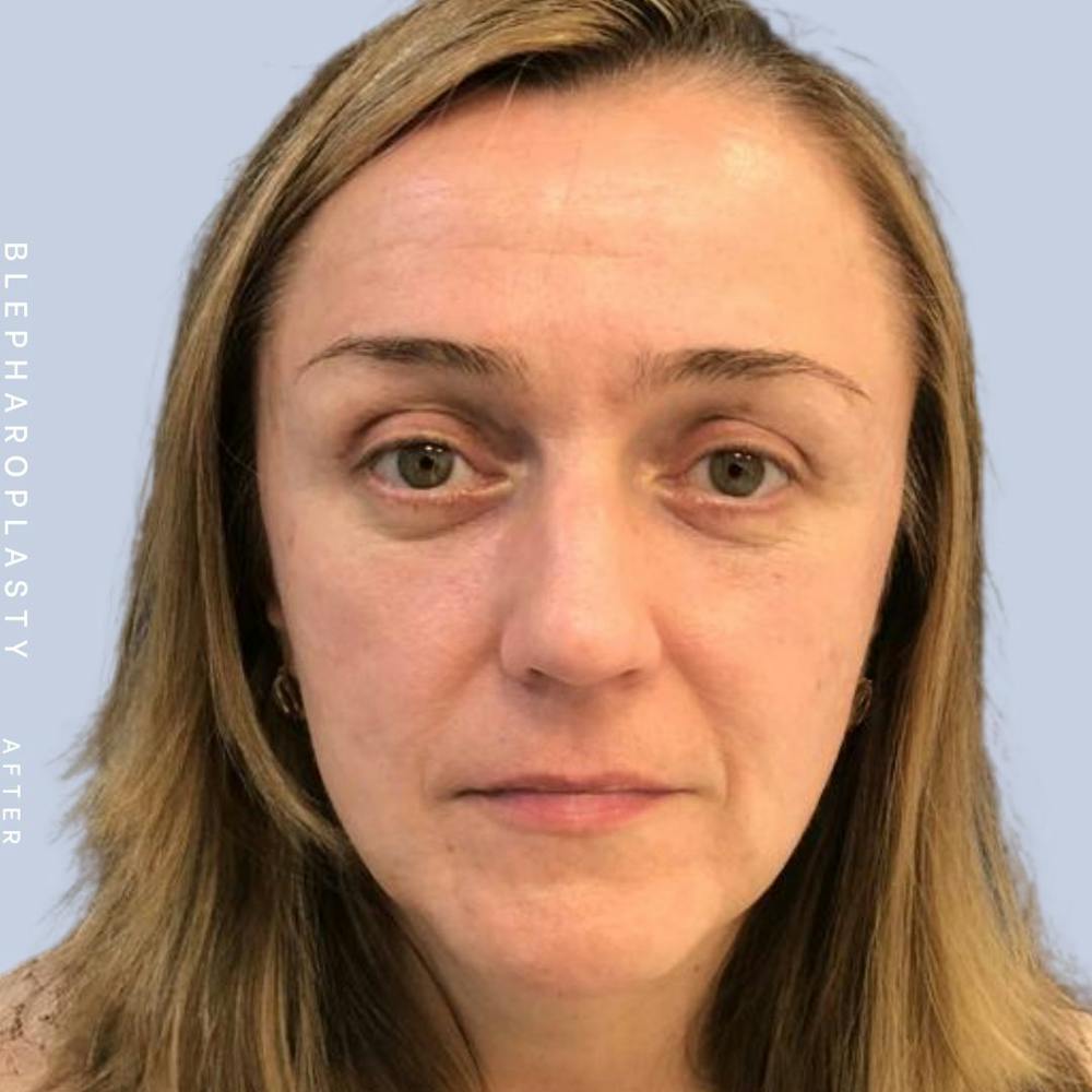 Eyes Before & After Gallery - Patient 121500210 - Image 2