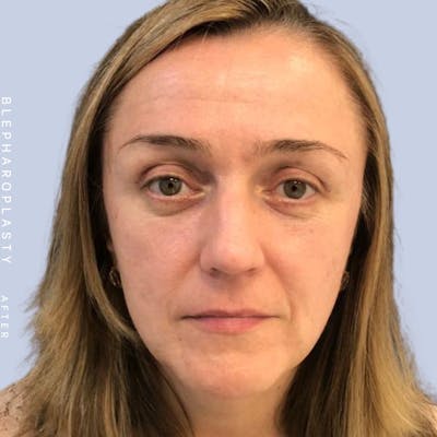 Eyes Before & After Gallery - Patient 121500210 - Image 2