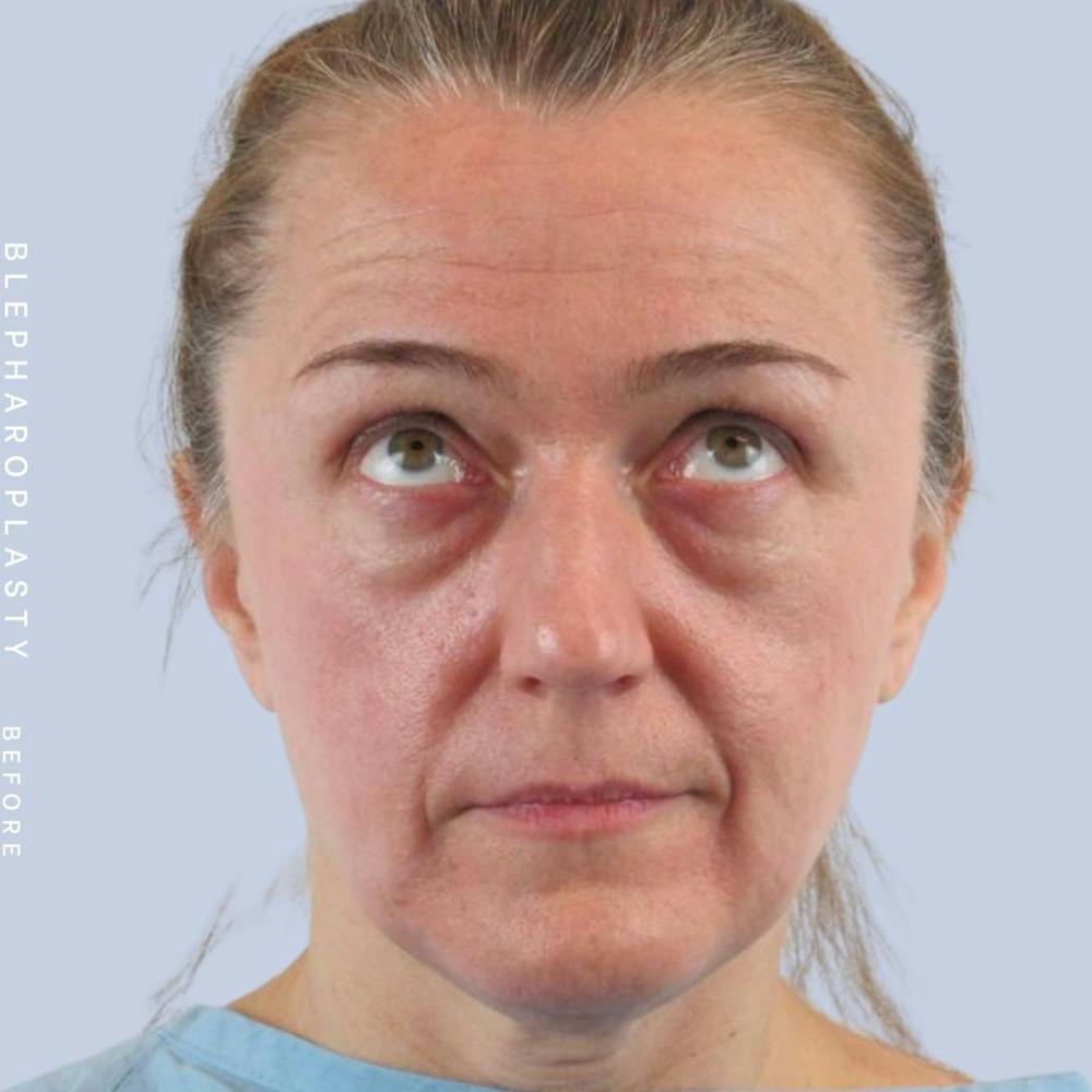 Eyes Before & After Gallery - Patient 121500210 - Image 3
