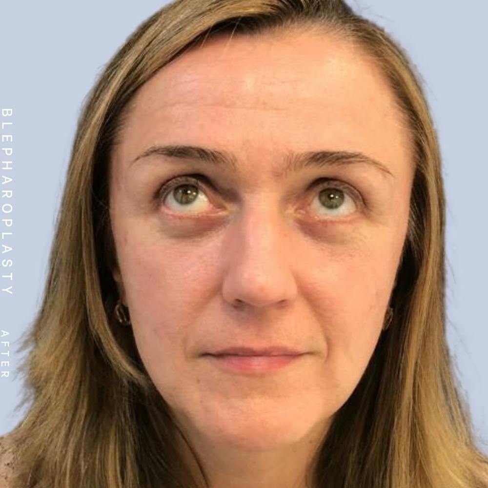 Eyes Before & After Gallery - Patient 121500210 - Image 4