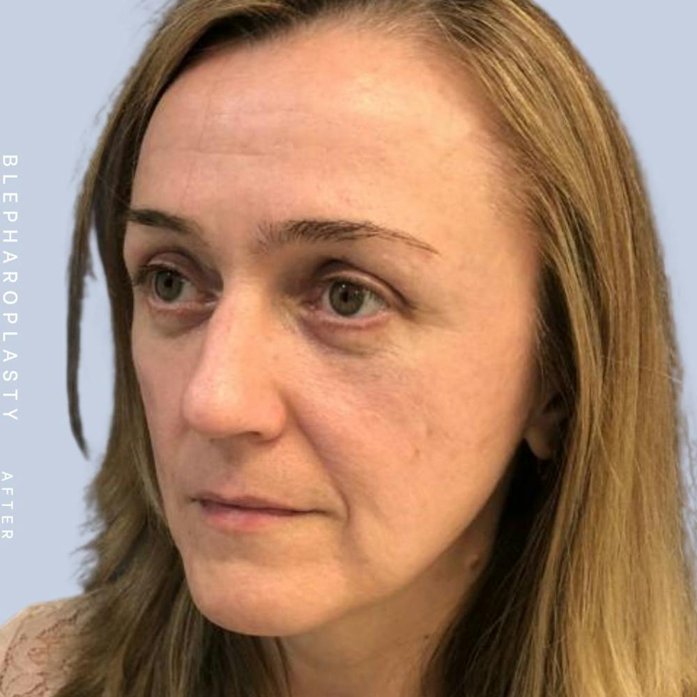 Eyes Before & After Gallery - Patient 121500210 - Image 6