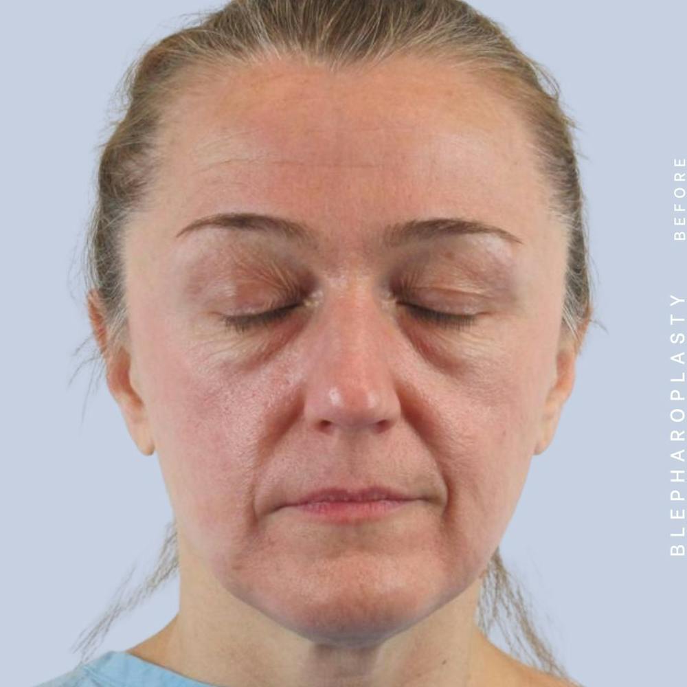 Eyes Before & After Gallery - Patient 121500210 - Image 7