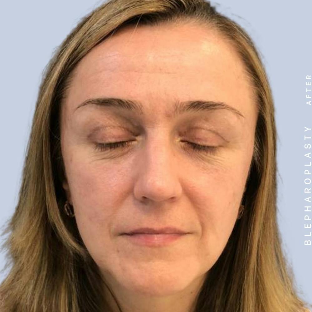 Eyes Before & After Gallery - Patient 121500210 - Image 8