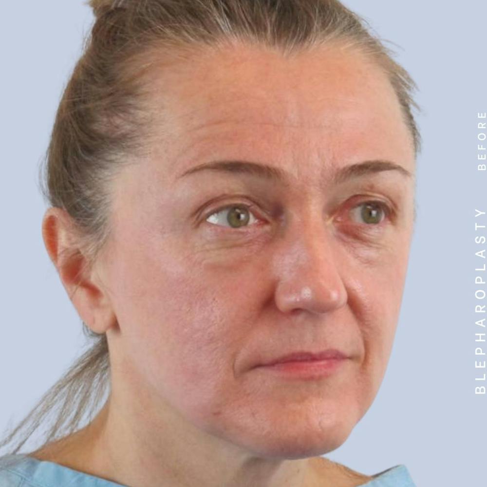 Eyes Before & After Gallery - Patient 121500210 - Image 9