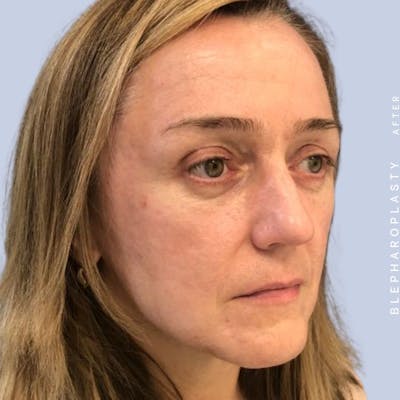 Eyes Before & After Gallery - Patient 121500210 - Image 10