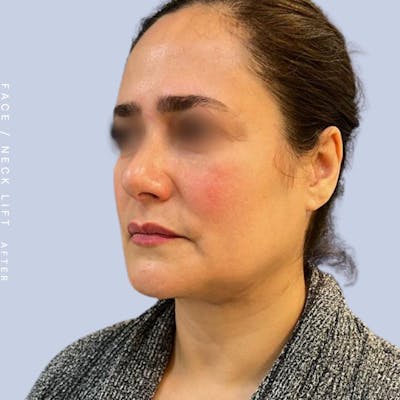 Face & Neck Before & After Gallery - Patient 122053840 - Image 2