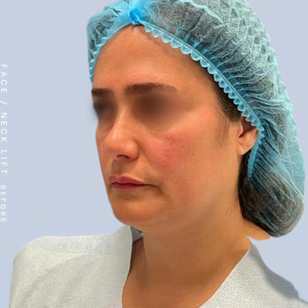 Face & Neck Before & After Gallery - Patient 122053840 - Image 1