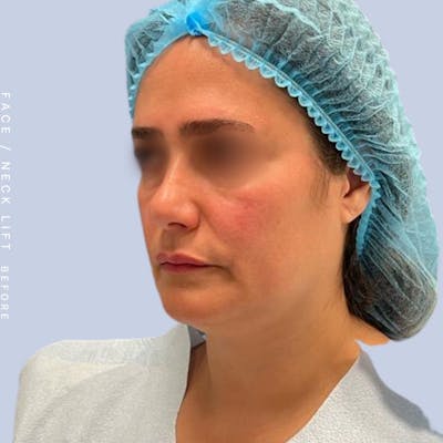 Face & Neck Before & After Gallery - Patient 122053840 - Image 1