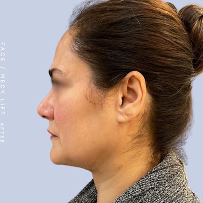 Face & Neck Before & After Gallery - Patient 122053840 - Image 4