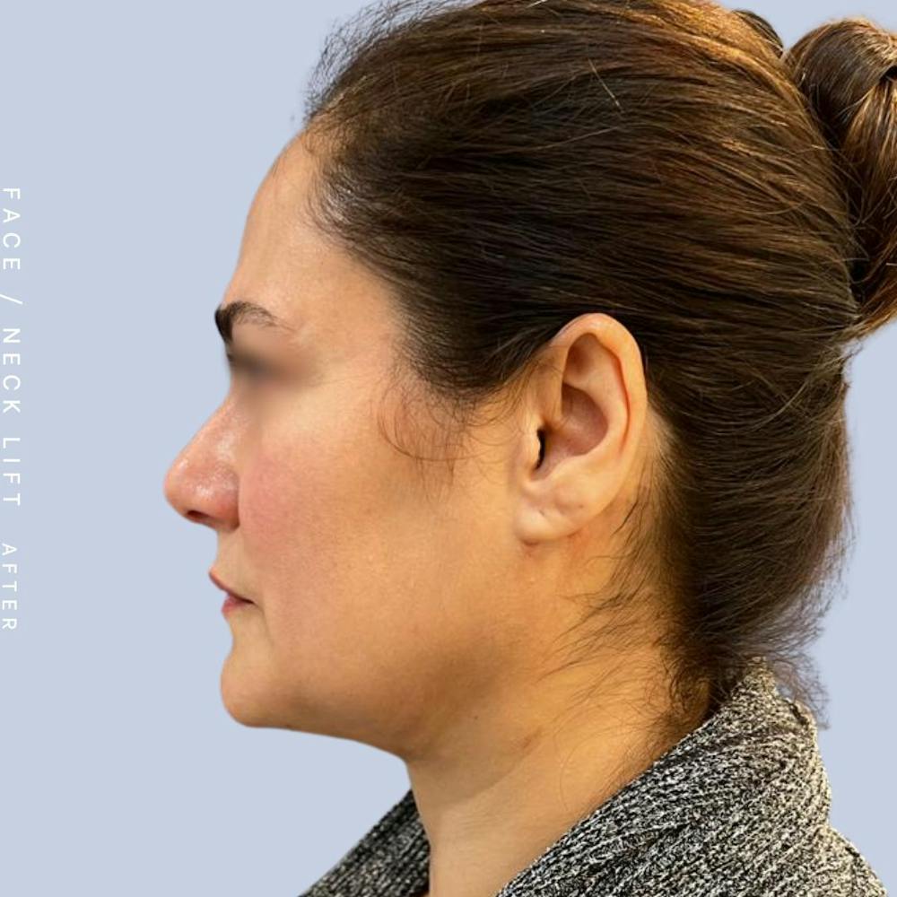 Face & Neck Before & After Gallery - Patient 122053840 - Image 4